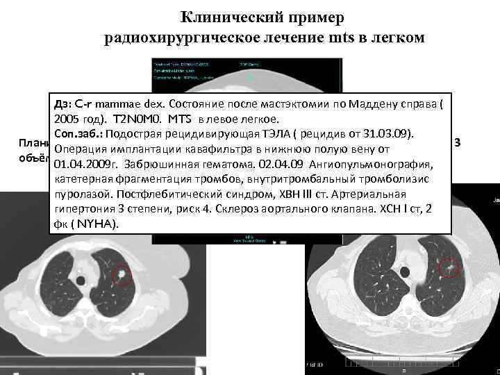 Клинический пример радиохирургическое лечение mts в легком Дз: C-r mammae dex. Состояние после маcтэктомии