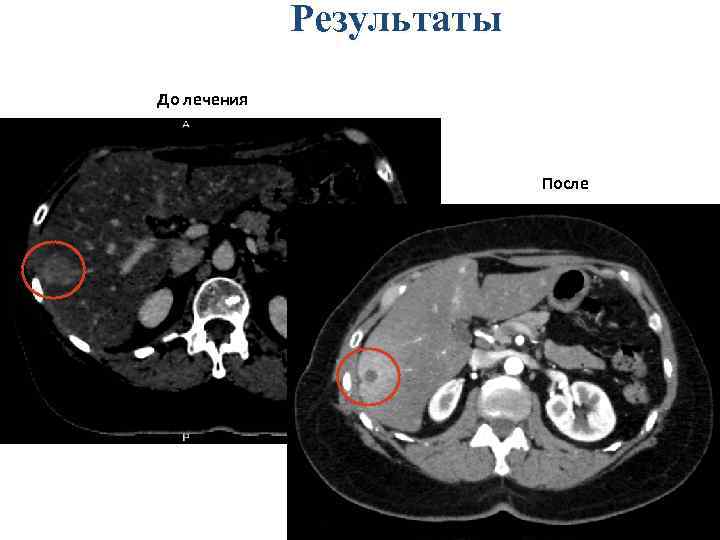 Результаты До лечения После 