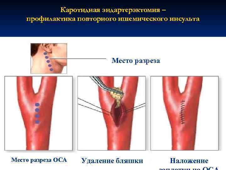 Каротидная эндартерэктомия – профилактика повторного ишемического инсульта Место разреза ОСА Удаление бляшки Наложение 