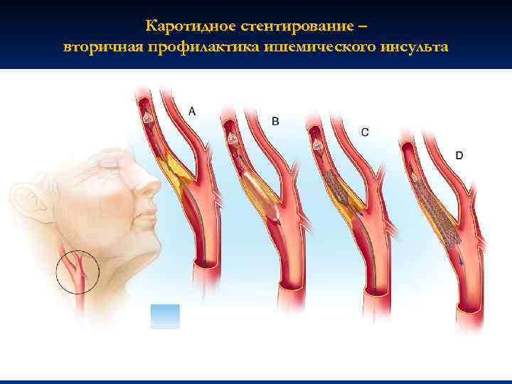 Каротидное стентирование – вторичная профилактика ишемического инсульта 