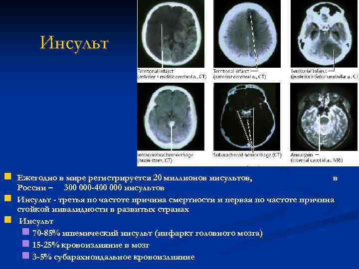 Инсульт Ежегодно в мире регистрируется 20 миллионов инсультов, в России – 300 000 -400