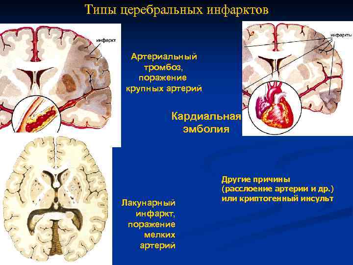 Типы церебральных инфарктов Артериальный тромбоз, поражение крупных артерий Кардиальная эмболия Лакунарный инфаркт, поражение мелких
