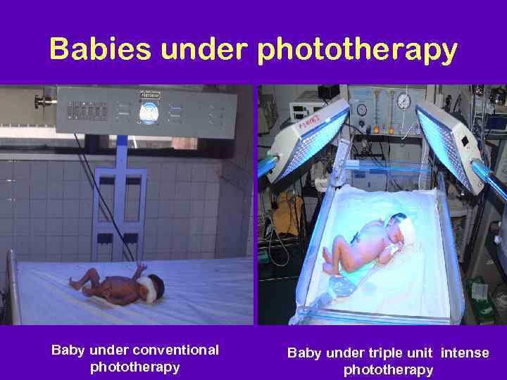 Babies under phototherapy Baby under conventional phototherapy Baby under triple unit intense phototherapy 