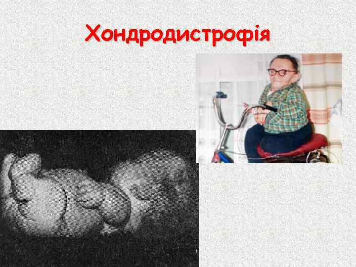 Хондродистрофія 