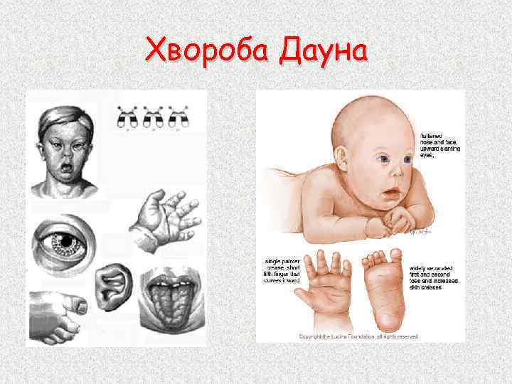 Фенотип ребенка с синдромом дауна. Фенотип при синдроме Дауна.