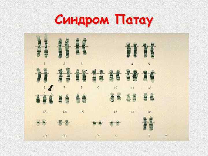 Синдром Патау 