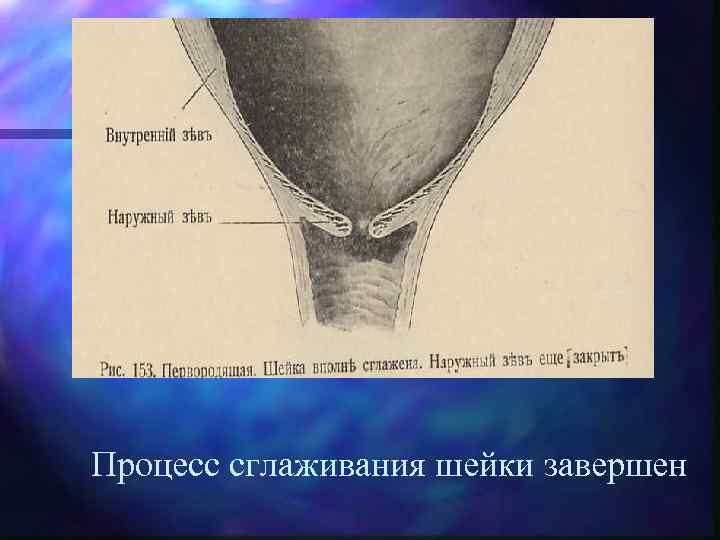 Процесс сглаживания шейки завершен 