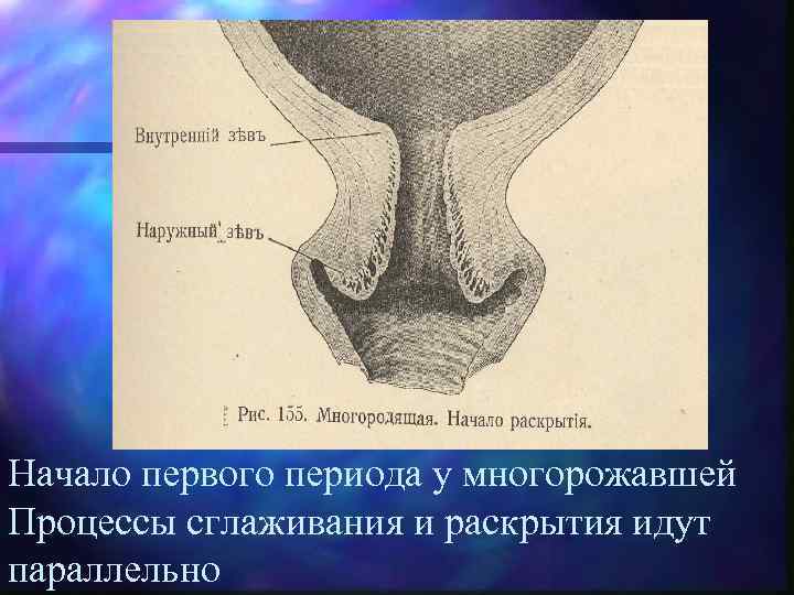 Начало первого периода у многорожавшей Процессы сглаживания и раскрытия идут параллельно 