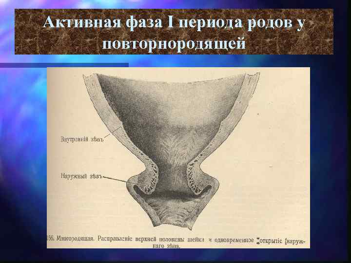 Активная фаза I периода родов у повторнородящей 
