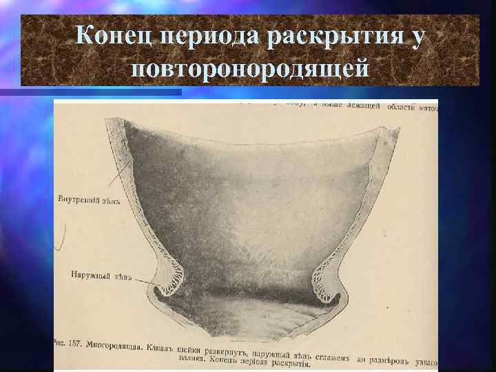 Конец периода раскрытия у повторонородящей 