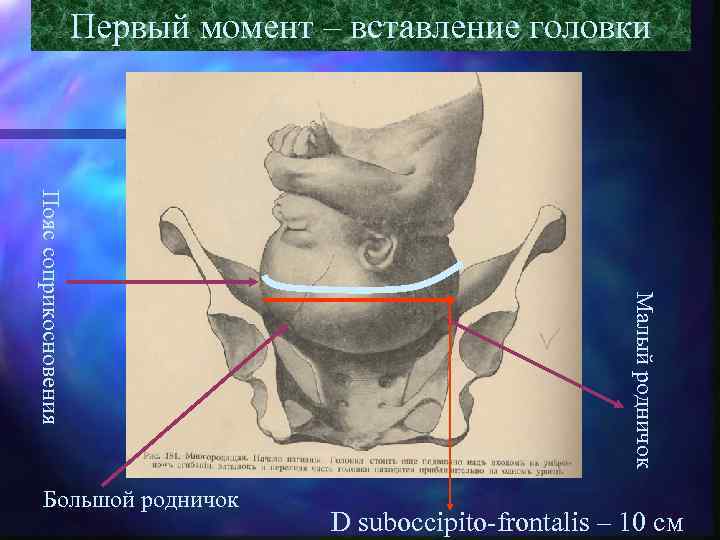 Первый момент – вставление головки Малый родничок Пояс соприкосновения Большой родничок D suboccipito-frontalis –
