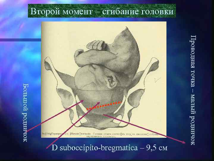 Второй момент – сгибание головки Проводная точка – малый родничок Большой родничок D suboccipito-bregmatica