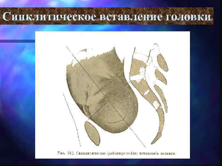 Синклитическое вставление головки 