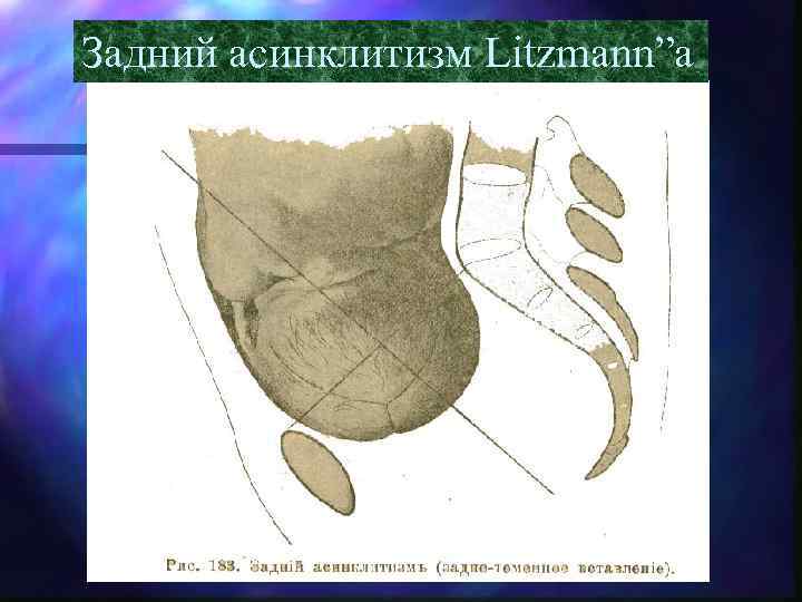 Задний асинклитизм Litzmann”a 