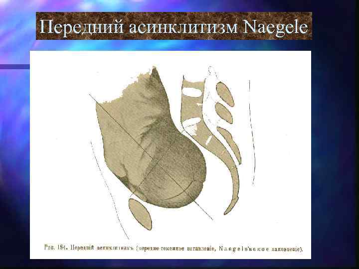 Передний асинклитизм Naegele 