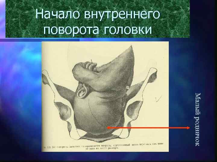 Начало внутреннего поворота головки Малый родничок 