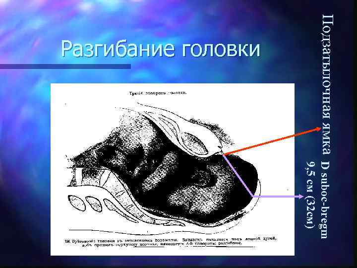 Подзатылочная ямка Разгибание головки D suboc-bregm 9, 5 см (32 см) 