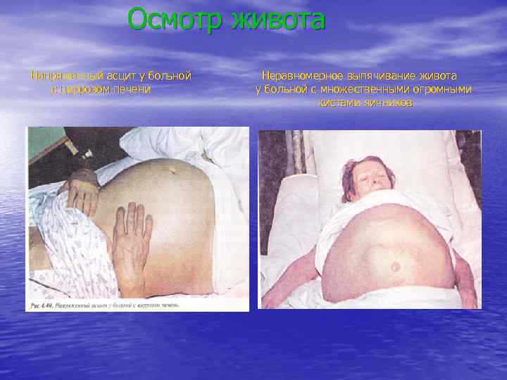 Осмотр живота Напряженный асцит у больной с циррозом печени Неравномерное выпячивание живота у больной