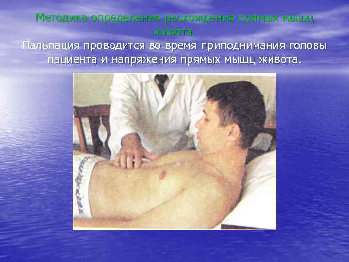 Методика определения расхождения прямых мышц живота. Пальпация проводится во время приподнимания головы пациента и