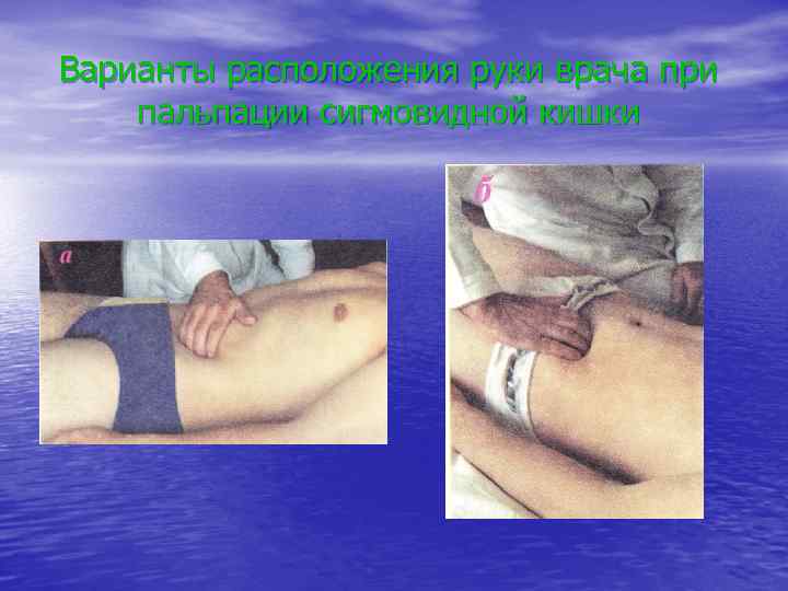 Варианты расположения руки врача при пальпации сигмовидной кишки 