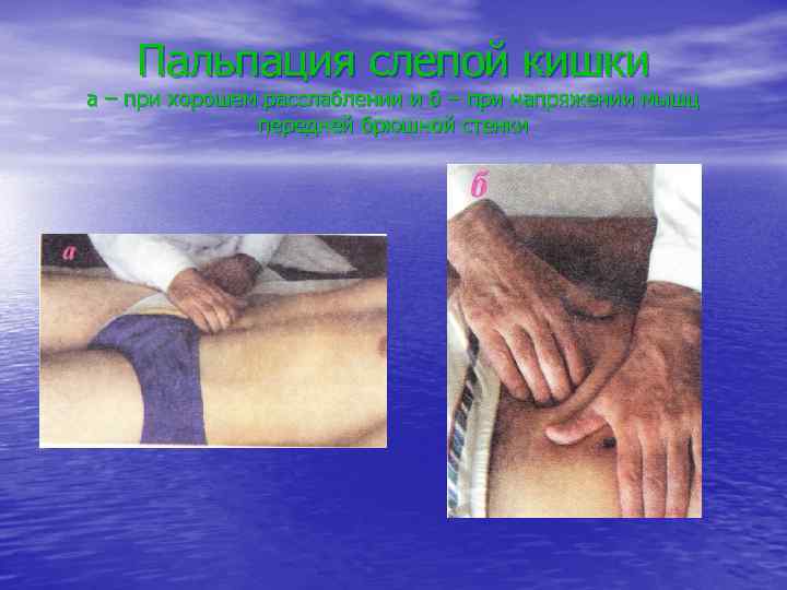 Пальпация слепой кишки а – при хорошем расслаблении и б – при напряжении мышц
