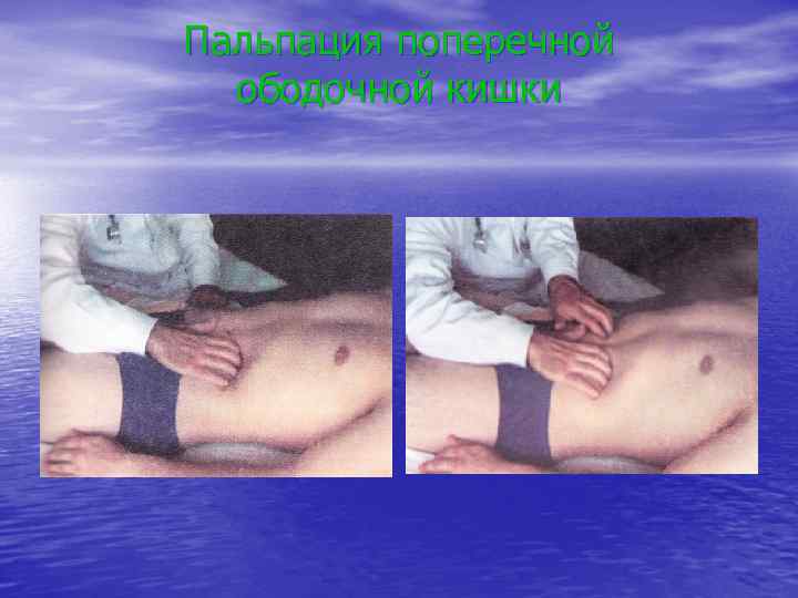 Пальпация поперечной ободочной кишки 