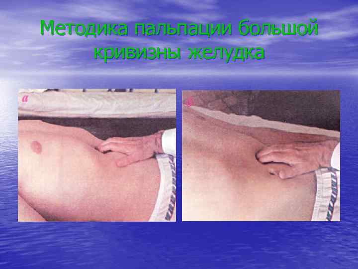 Методика пальпации большой кривизны желудка 