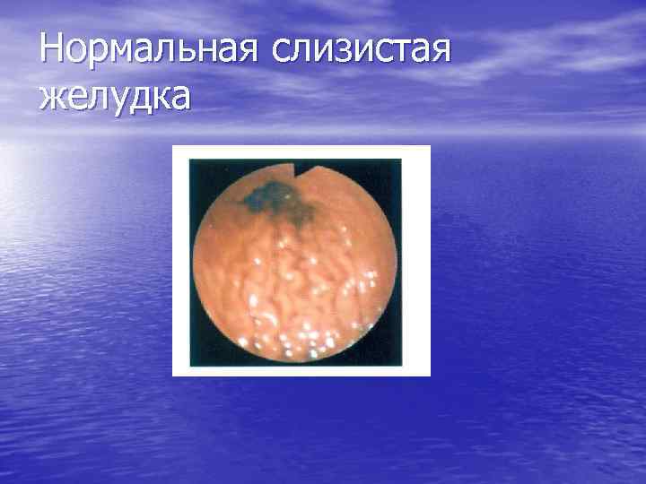 Нормальная слизистая желудка 