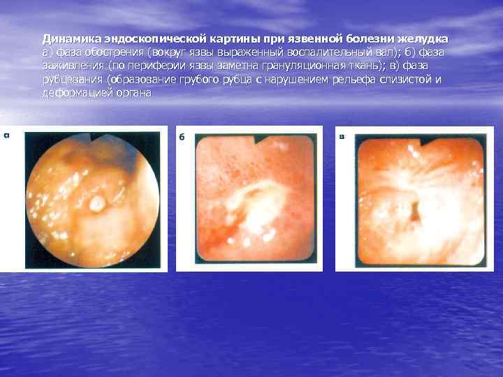 Динамика эндоскопической картины при язвенной болезни желудка а) фаза обострения (вокруг язвы выраженный воспалительный