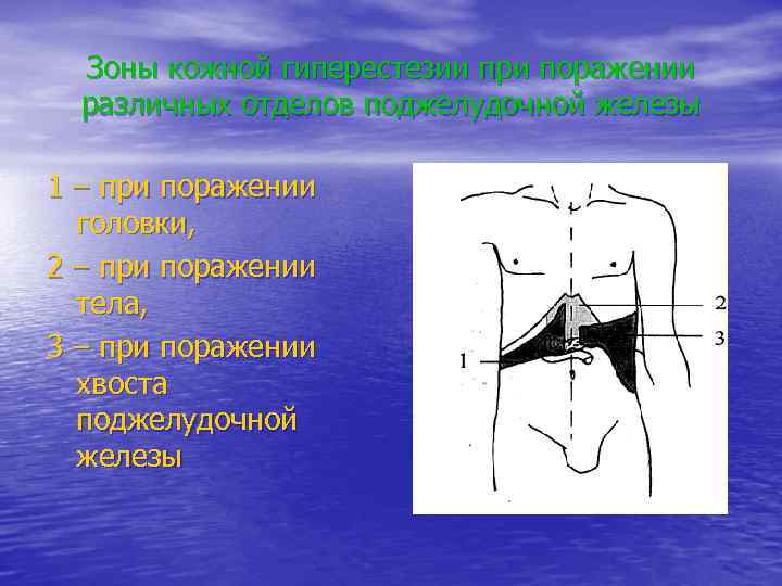Зоны кожной гиперестезии при поражении различных отделов поджелудочной железы 1 – при поражении головки,