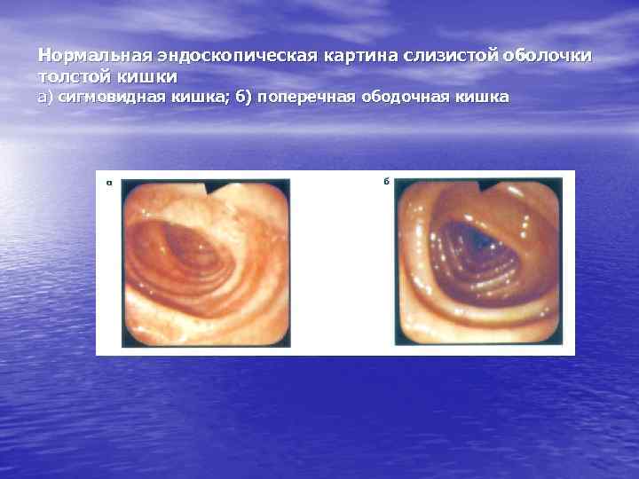Нормальная эндоскопическая картина слизистой оболочки толстой кишки а) сигмовидная кишка; б) поперечная ободочная кишка