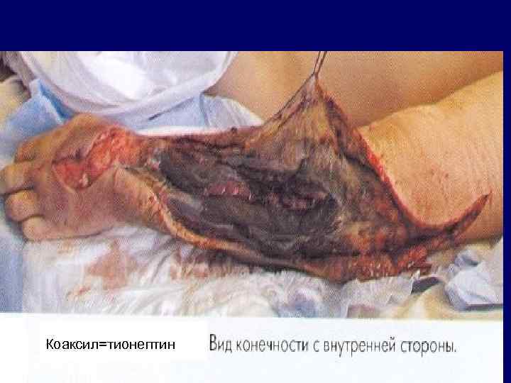 Коаксил=тионептин 