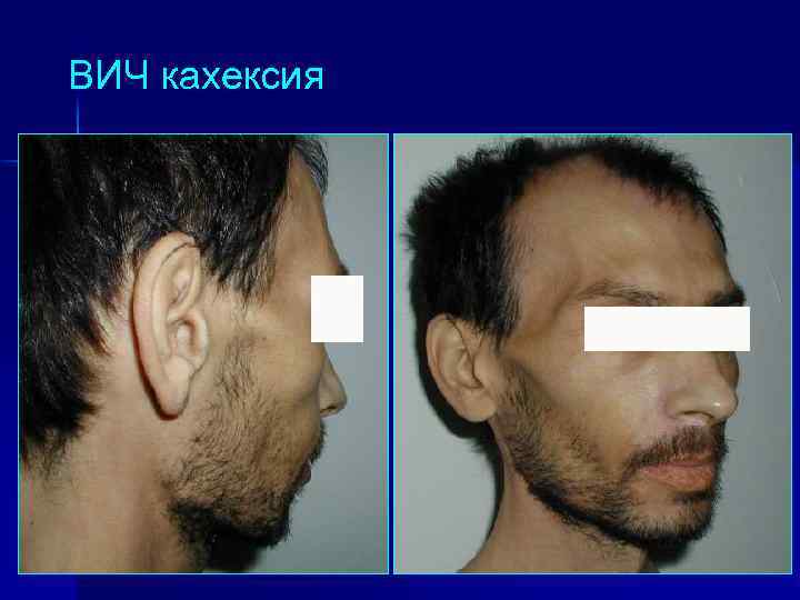 ВИЧ кахексия 