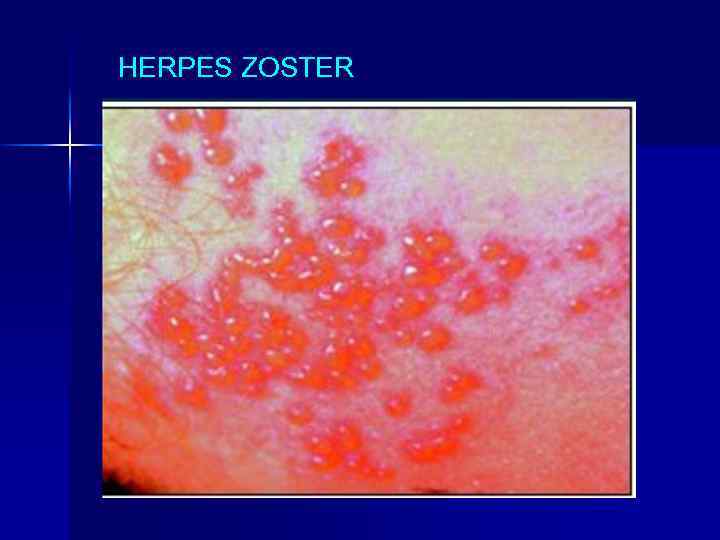 HERPES ZOSTER 