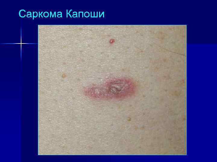 Саркома Капоши 