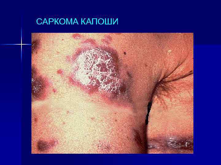 САРКОМА КАПОШИ 