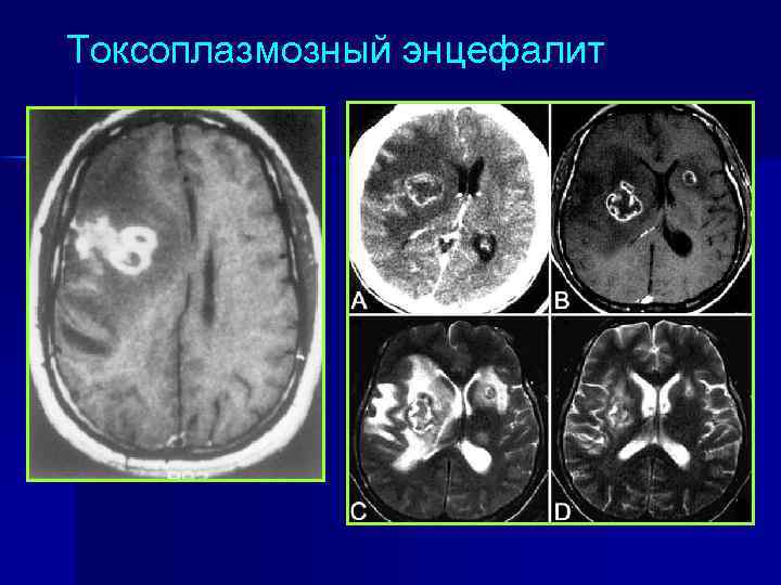 Токсоплазмозный энцефалит 