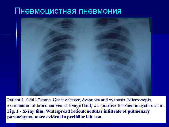 Пневмоцистная пневмония Patient 1. Cd 4 27/mmc. Onset of fever, dyspnoea and cyanosis. Microscopic