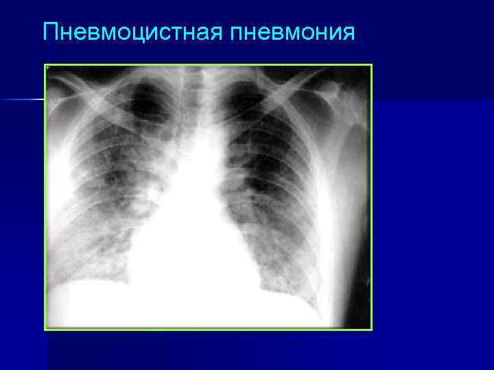 Пневмоцистная пневмония рентгенологическая картина