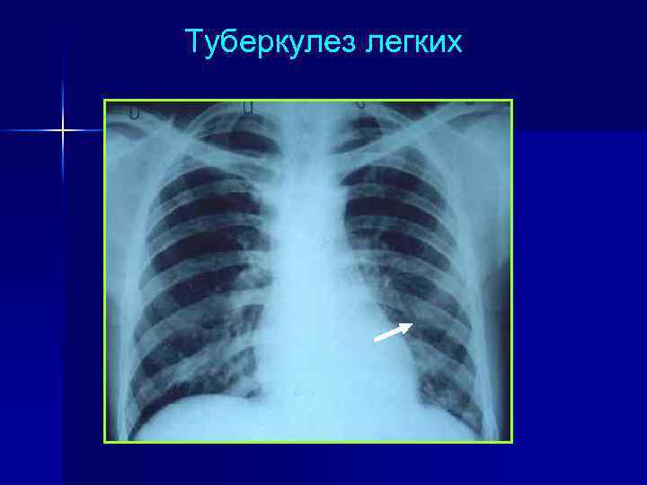 Клиническая картина и течение вич ассоциированного туберкулеза в основном обусловлены