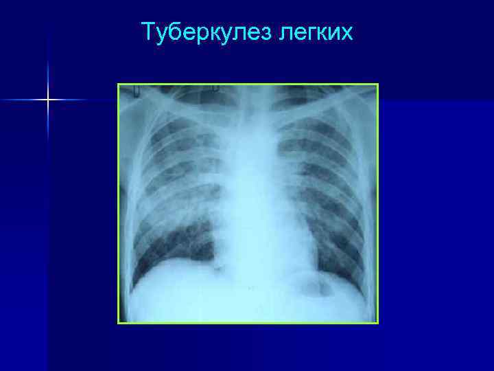 Туберкулез легких 