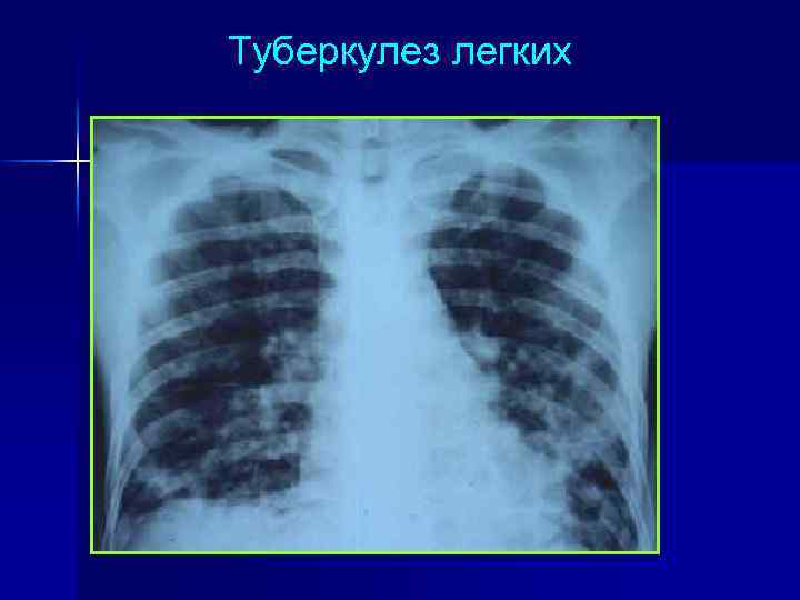 Туберкулез легких 