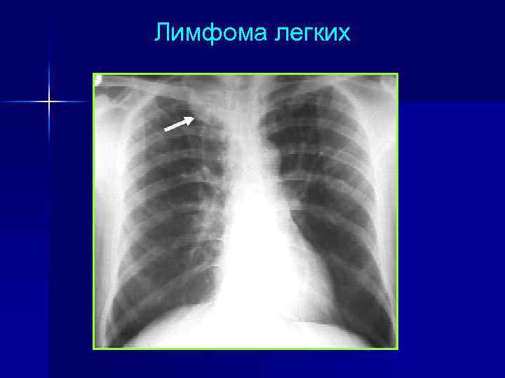 Лимфома легких 