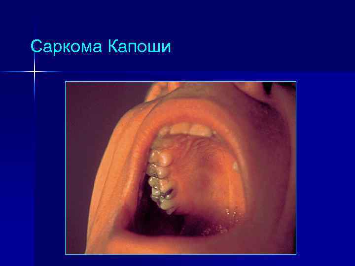 Саркома Капоши 