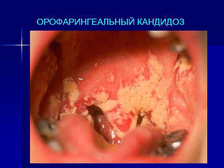 ОРОФАРИНГЕАЛЬНЫЙ КАНДИДОЗ 
