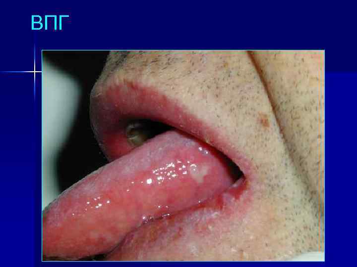 ВПГ 