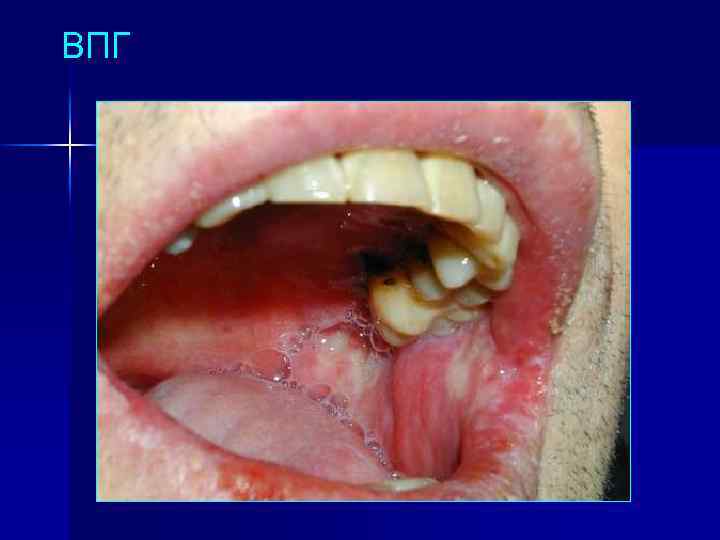 ВПГ 