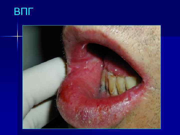 ВПГ 
