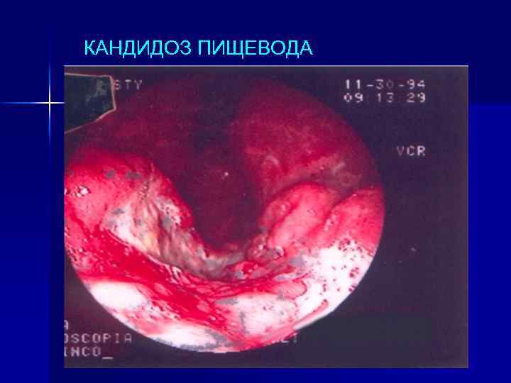 КАНДИДОЗ ПИЩЕВОДА 