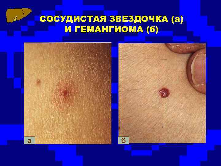 СОСУДИСТАЯ ЗВЕЗДОЧКА (а) И ГЕМАНГИОМА (б) а б 